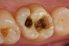 лечение заболеваний зубов 